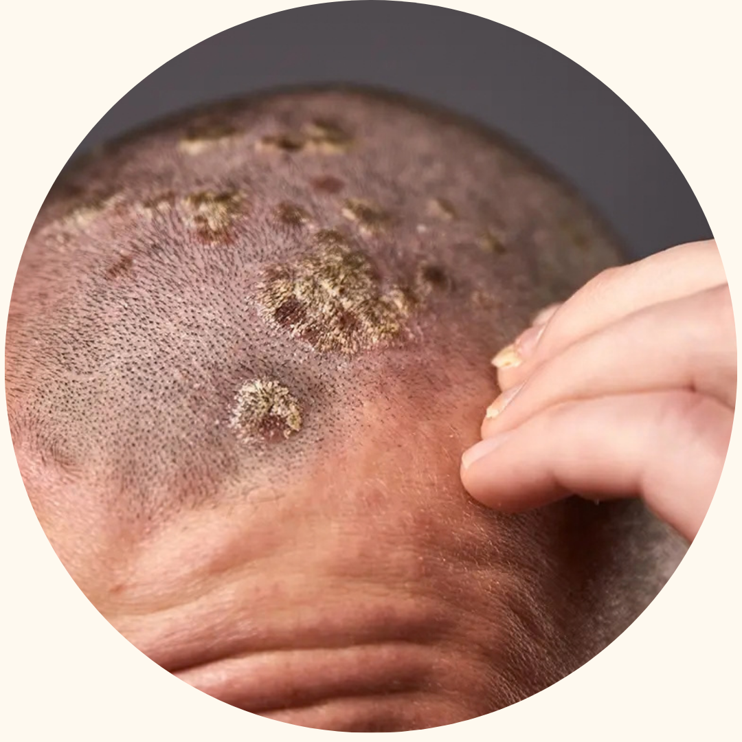 Psoriasis symptom example 8