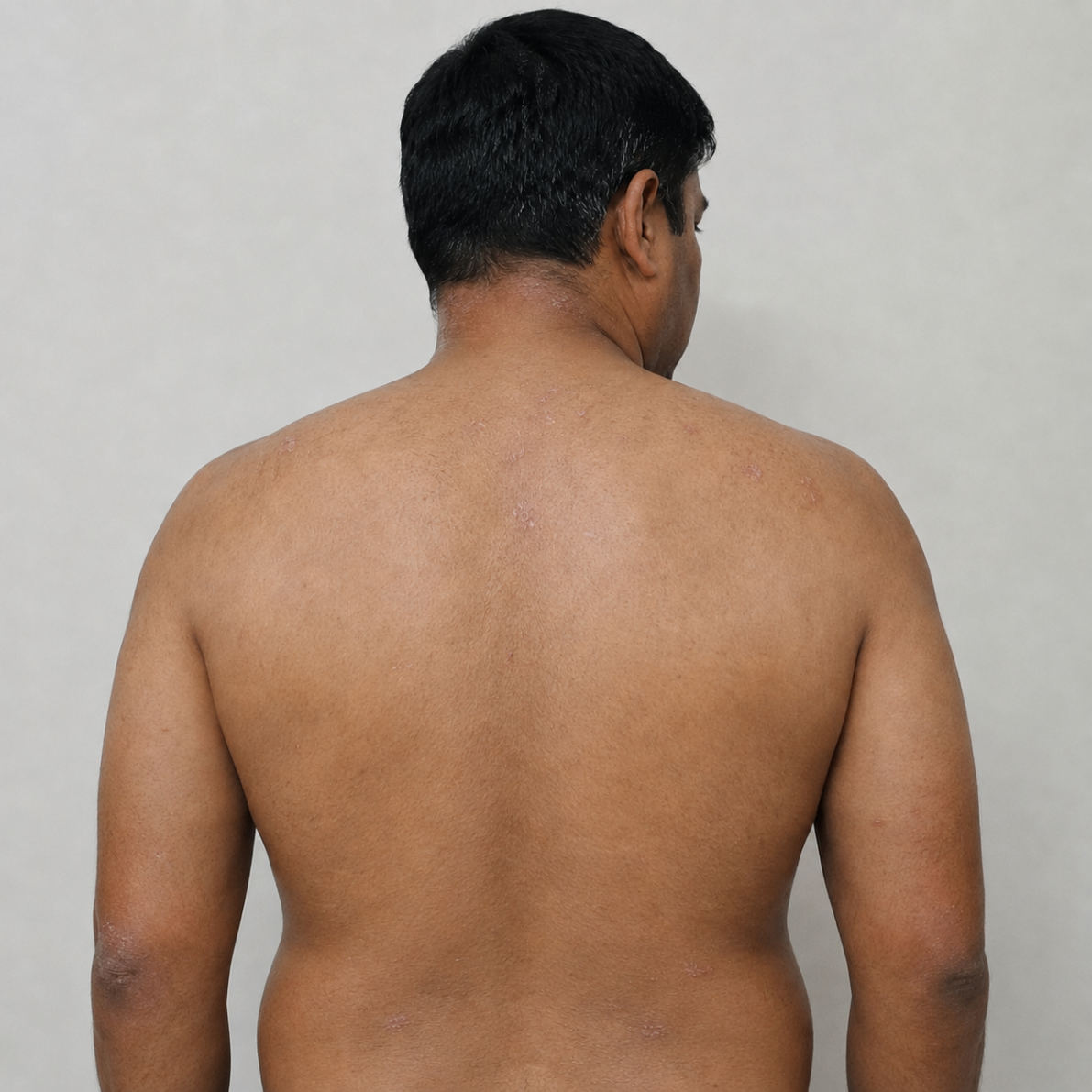 Back & Body Psoriasis after treatment