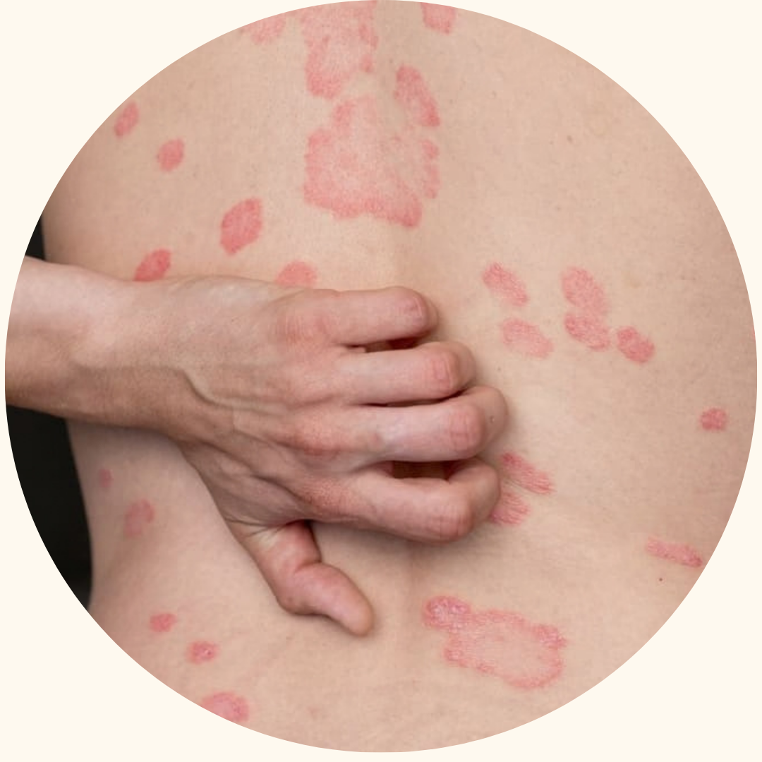 Psoriasis symptom example 2