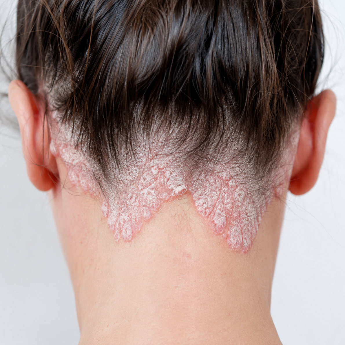 Scalp psoriasis at the hairline