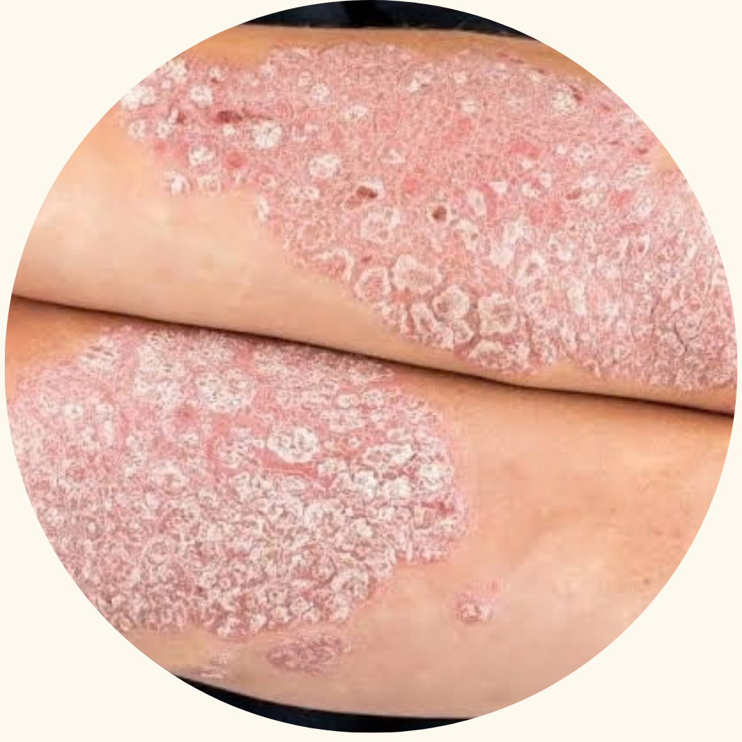 Psoriasis symptom example 4