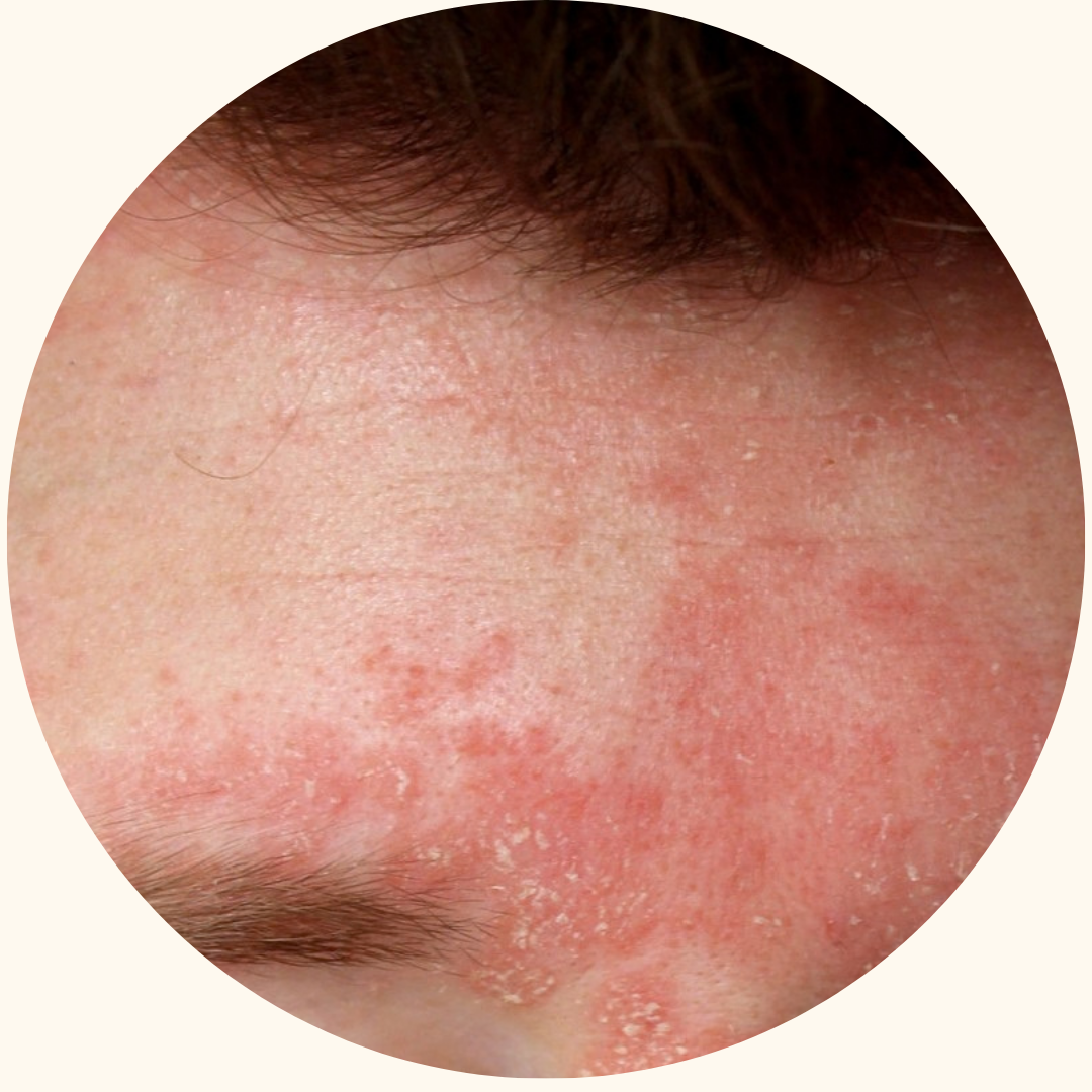 Psoriasis symptom example 5