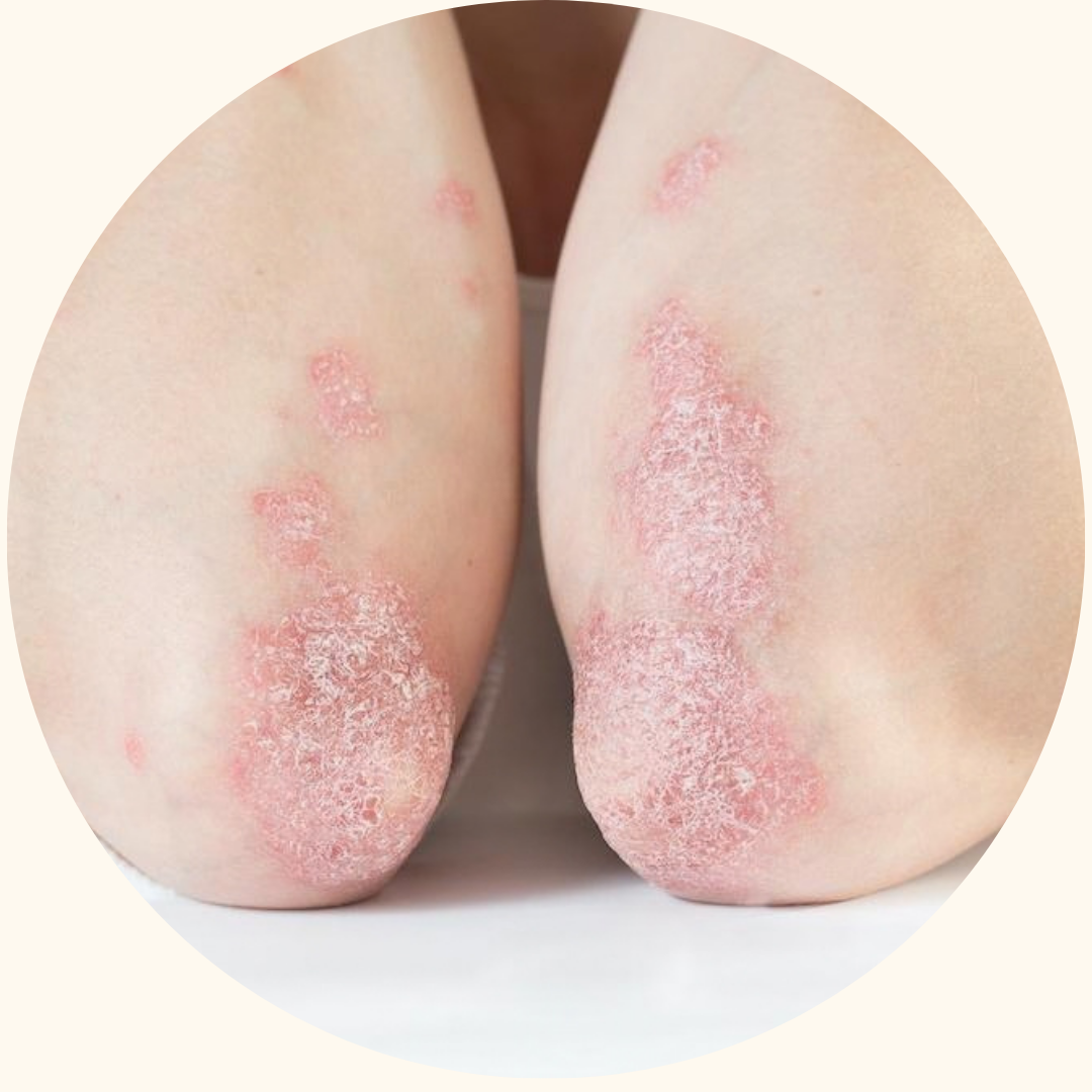Psoriasis symptom example 3