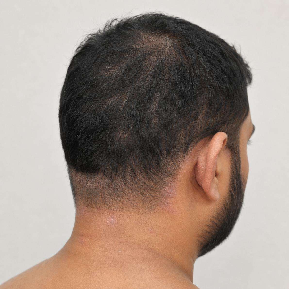 Scalp Psoriasis after treatment