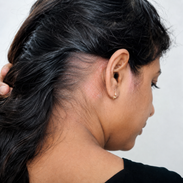 Female Scalp Psoriasis after treatment