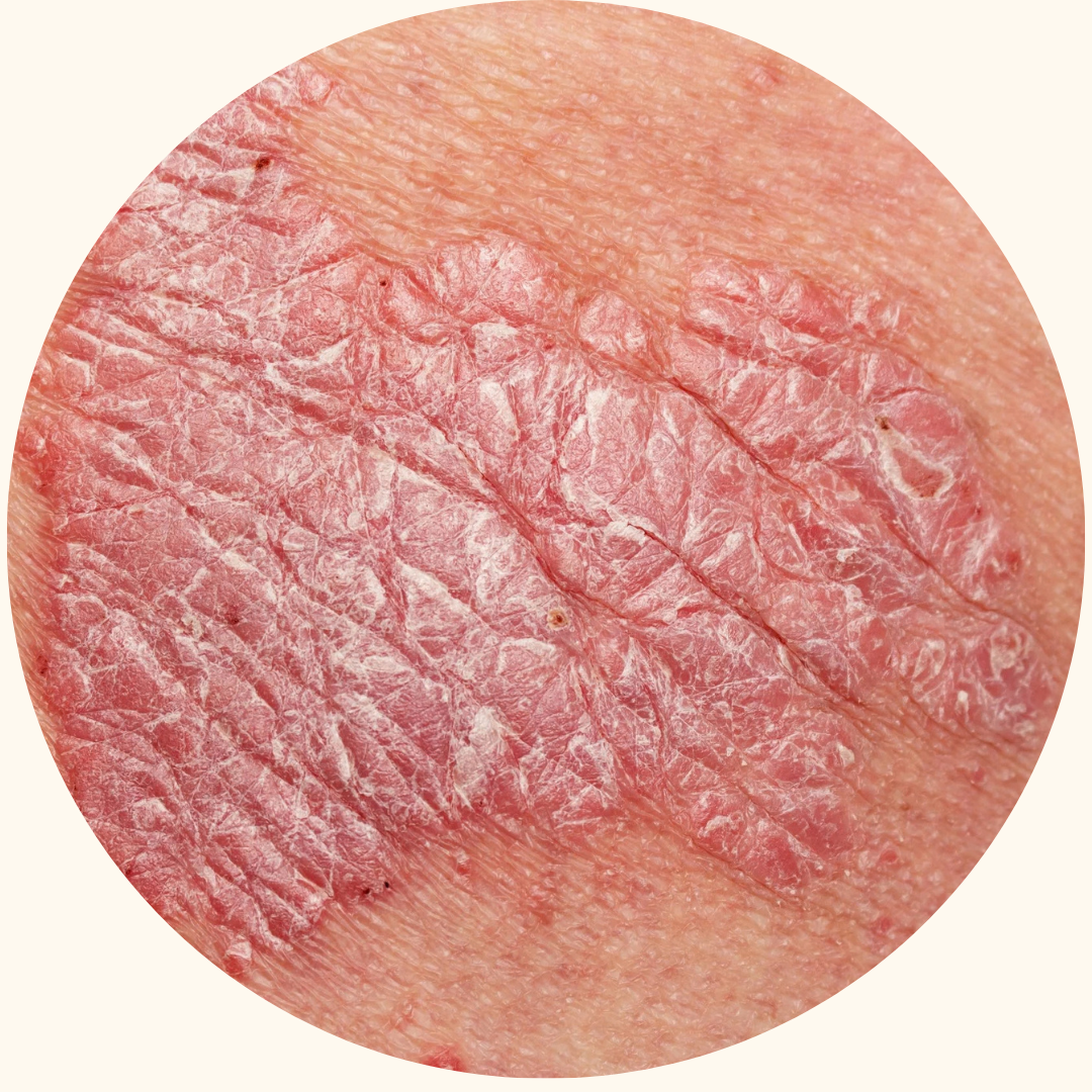 Psoriasis symptom example 9