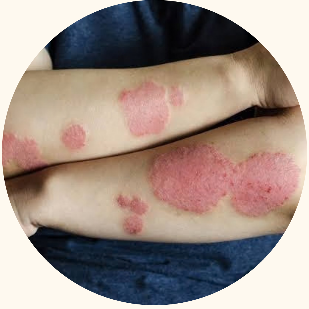 Psoriasis symptom example 1