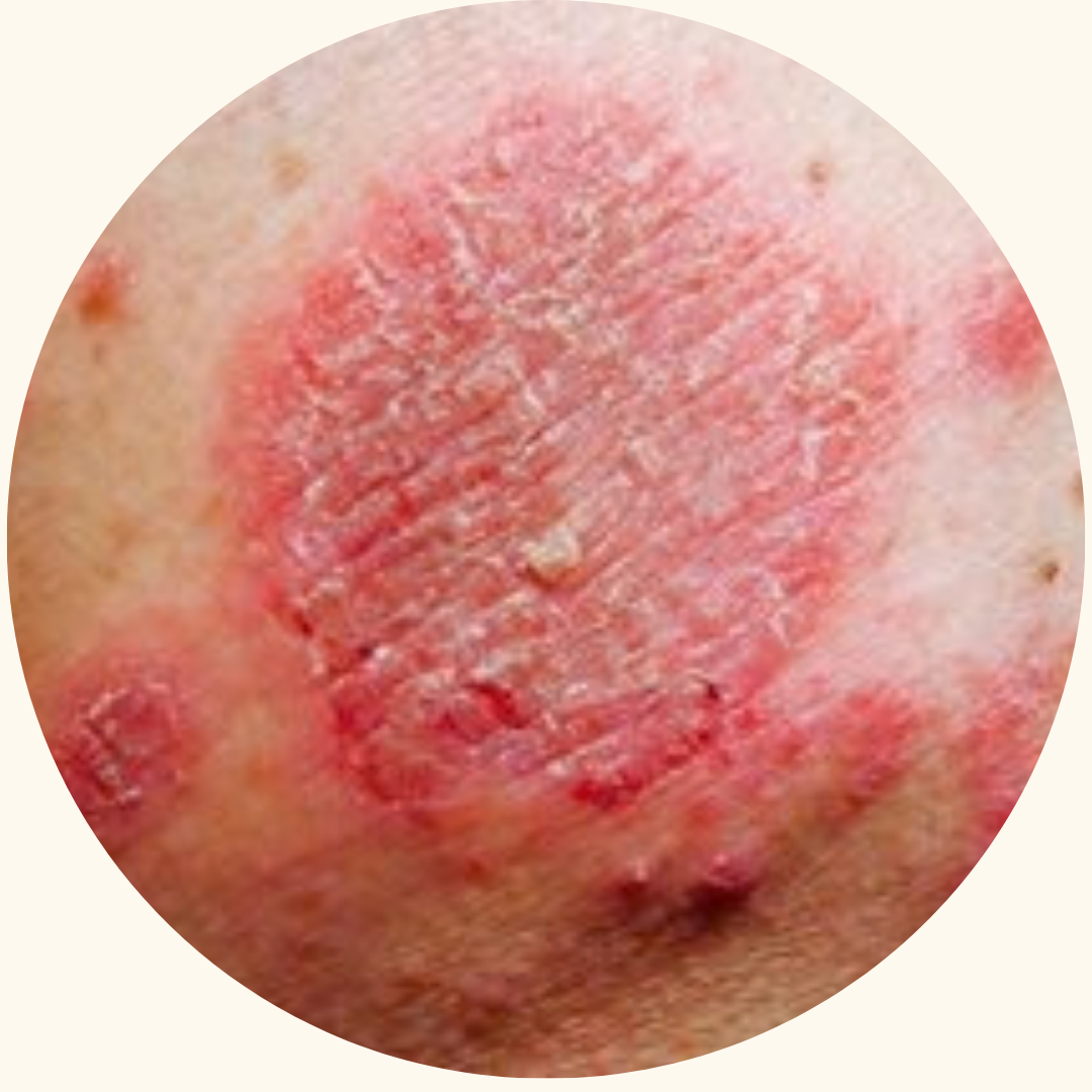 Psoriasis symptom example 7