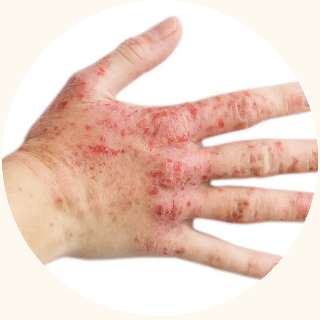 Psoriasis symptom example 13
