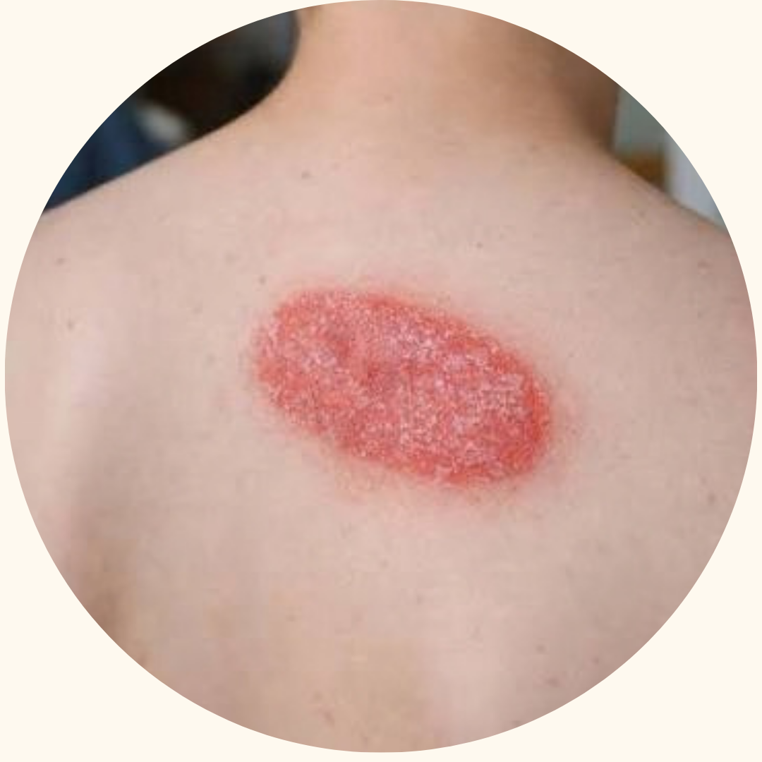 Psoriasis symptom example 11