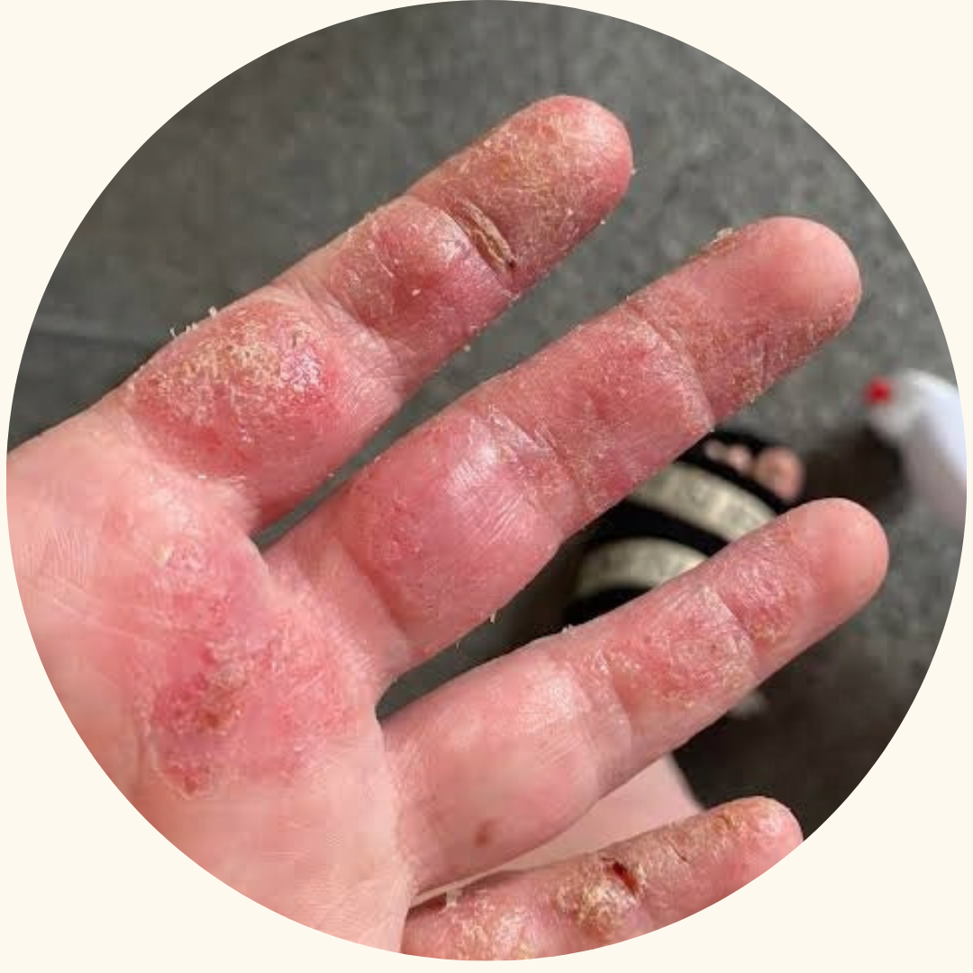 Psoriasis symptom example 12
