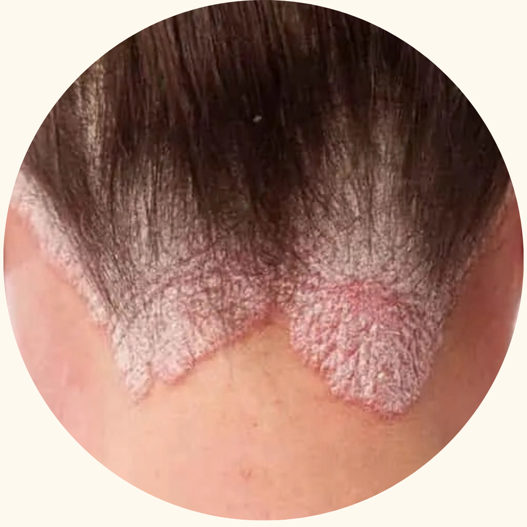 Psoriasis symptom example 6